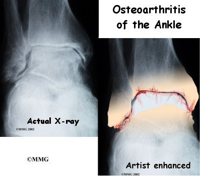 Arthritis Ankle