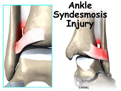 Ankle Syndesmosis Injuries | Orthogate