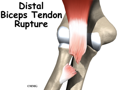 ripped bicep tendon