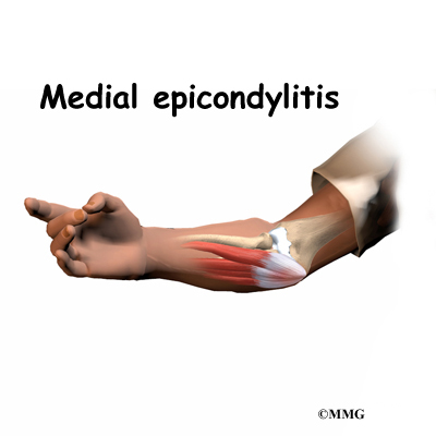 Elbow Epicondylitis