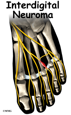 Hand Neuroma