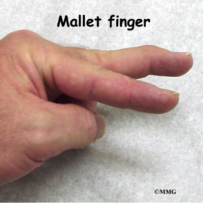 mallet finger injury