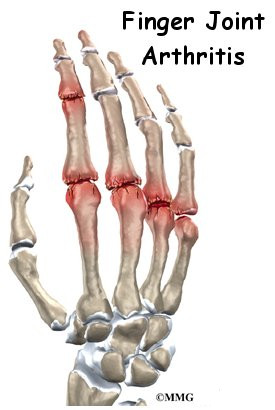 Arthritis Hand Surgery