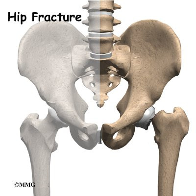 Mri Hip Fracture