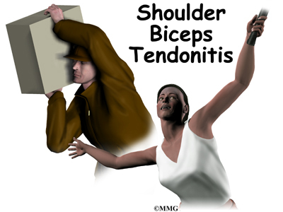 Bicep Tendonitis Exercises