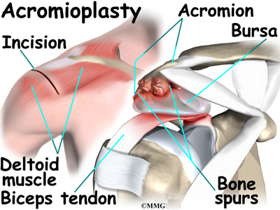 Acromion Injury