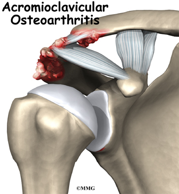 ac joint osteoarthritis