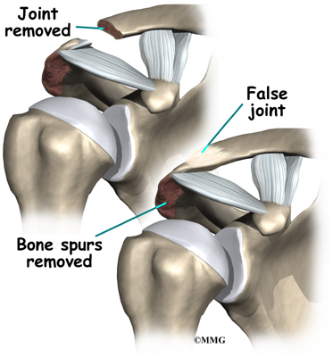 ac joint osteoarthritis