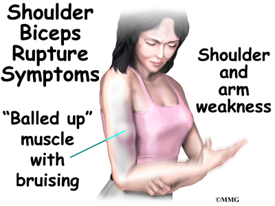 shoulder_biceps_rupture_symptoms01.jpg