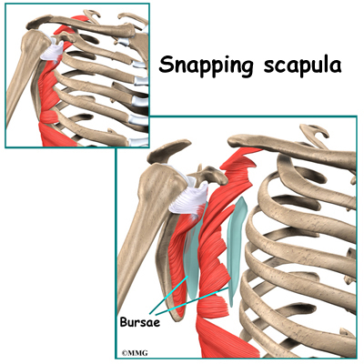 Snapping Scapula Syndrome | Orthogate