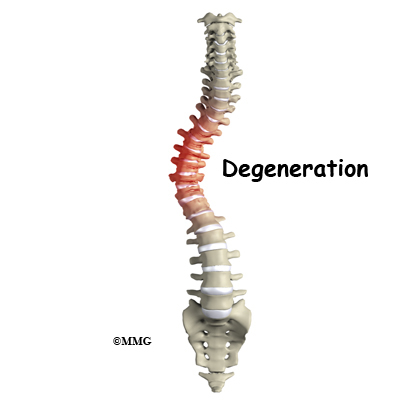 scoliosis adult degenerative spine cause patient treatments eorthopod degeneration uneven shoulders vertebrae pain hips causes conditions