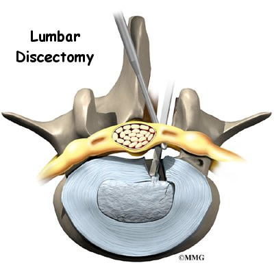How long does a lumbar discectomy last?