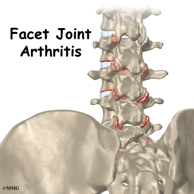 facet joint arthropathy