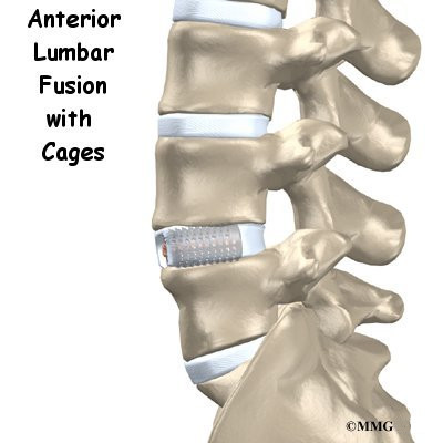 Spinal Cage