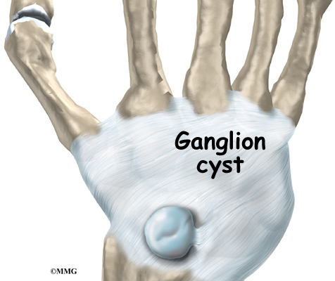 wrist ganglia