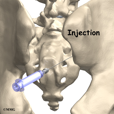 Epidural steroid injection infection symptoms