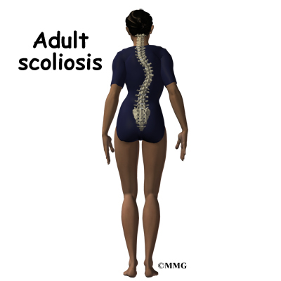 scoliosis Adult in