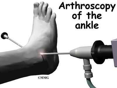 How much does it cost on average to have ankle fusion surgery?