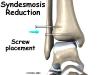 ankle_syndesmosis_surgery01.thumbnail.jpg