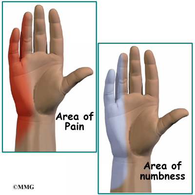 What causes right hand numbness?