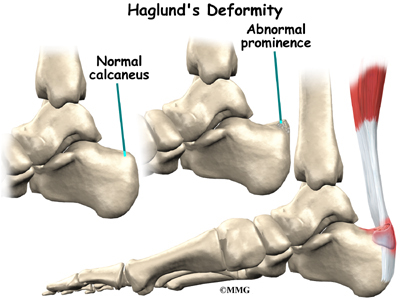 haglund's deformity pain relief