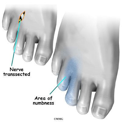 skin split between toes #11