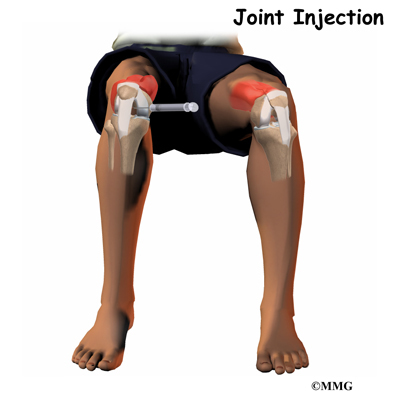 Corticosteroid knee injection procedure