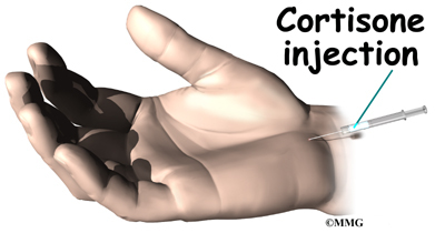 Steroid injections for carpal tunnel syndrome