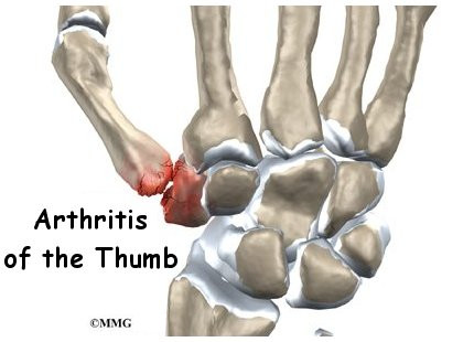 How long does it take to recuperate after basal joint arthritis surgery?