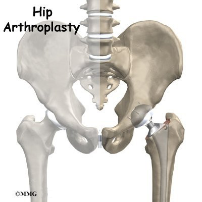 What should you expect during a full hip arthroplasty?