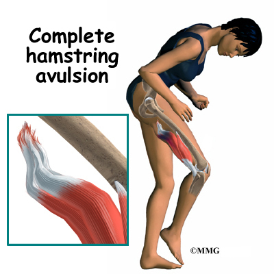 What kind of injury is an avulsion?