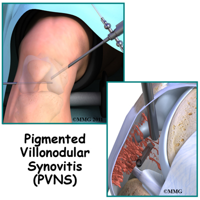 What are some treatment options for synovial cyst knee problems?