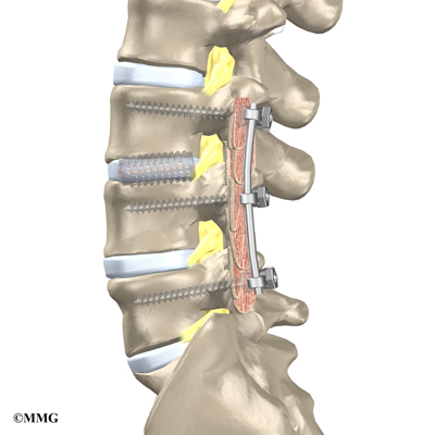 What is involved in spinal fusion surgery?