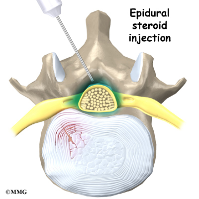 Epidural space steroid injections