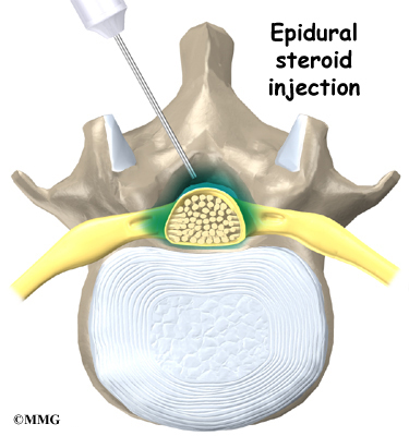 Epidural steroid injection lumbar disc