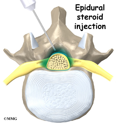 Epidural steroid injection lumbar disc
