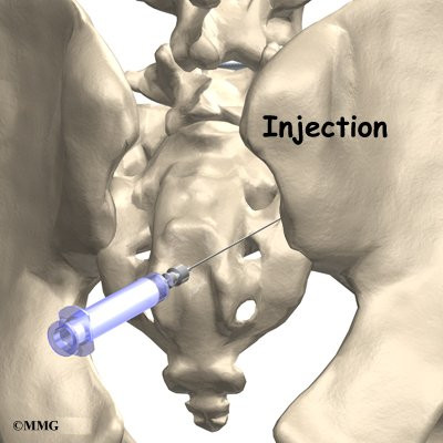 Sacroiliac joint steroid injection
