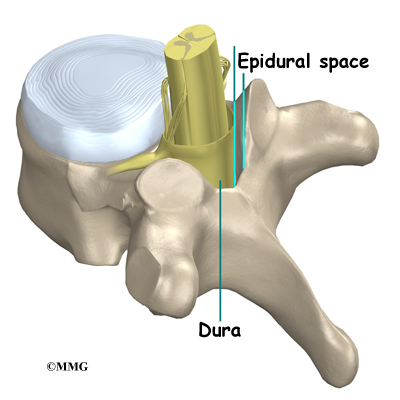 Sacral caudal epidural steroid injection