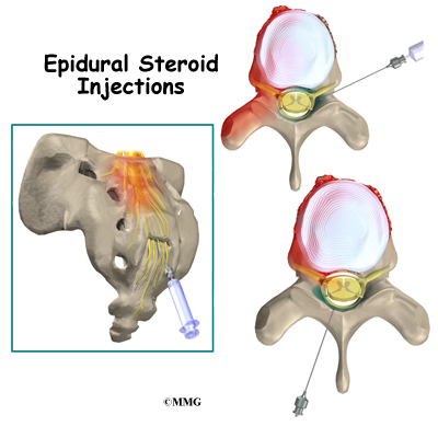 Steroid injection sites diagram