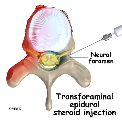 Cervical transforaminal epidural steroid injection technique
