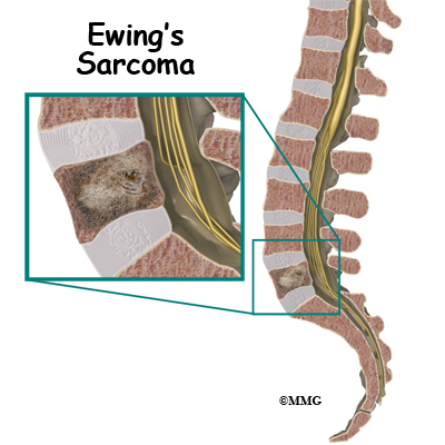 What is spine cancer called?