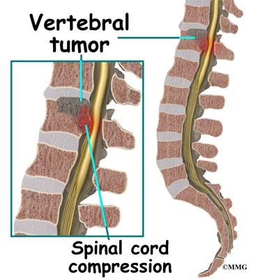 What are treatments for spinal lesions?