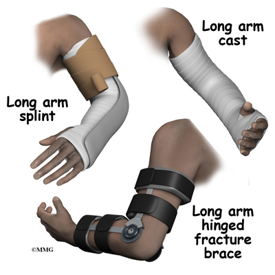 closed fracture treatment