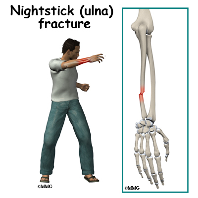 symptoms of adult buckle fracture wrist