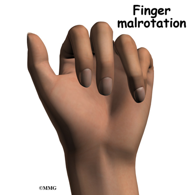 compression fracture treatment finger