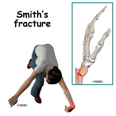radial smith fracture with reduction cpt code