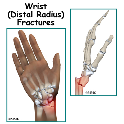 distal fractures fracture nerve verdict orthopedic affirmed posterior supination