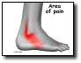 [ankle_peroneal_sublux_symptoms01.jpg]