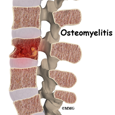 osteomyelitis in the lower back