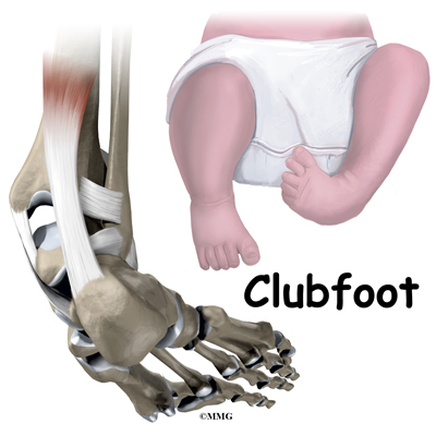 On the cure of club-foot without cutting tendons : and on certain